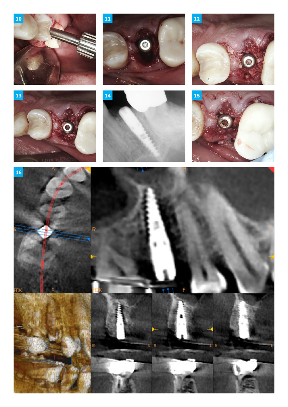 Dental Implant Continuum With DSI Implants And Products. Case 3