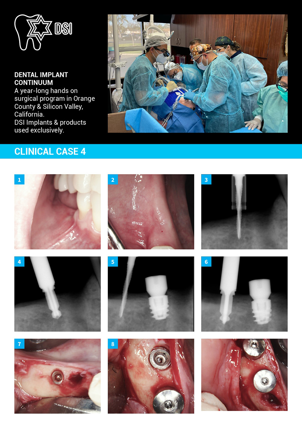 Dental Implant Continuum With DSI Implants And Products. Case 4